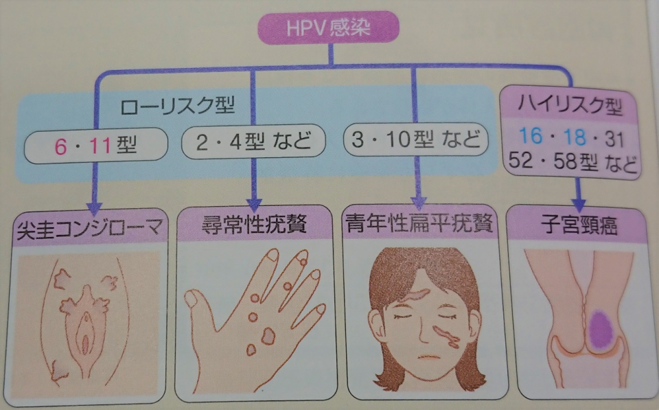 HPV①